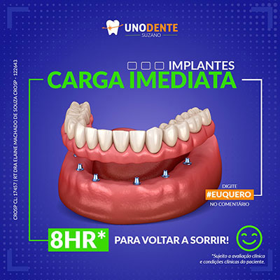 Implantes Dentários